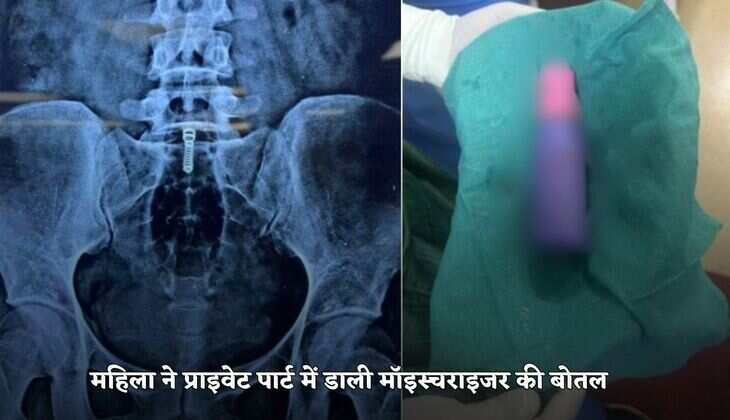 Delhi News: ये सुख प्राप्त करने के लिए महिला ने प्राइवेट पार्ट में डाली मॉइस्चराइजर की बोतल, डॉक्टरों ने इस जगह से निकाली